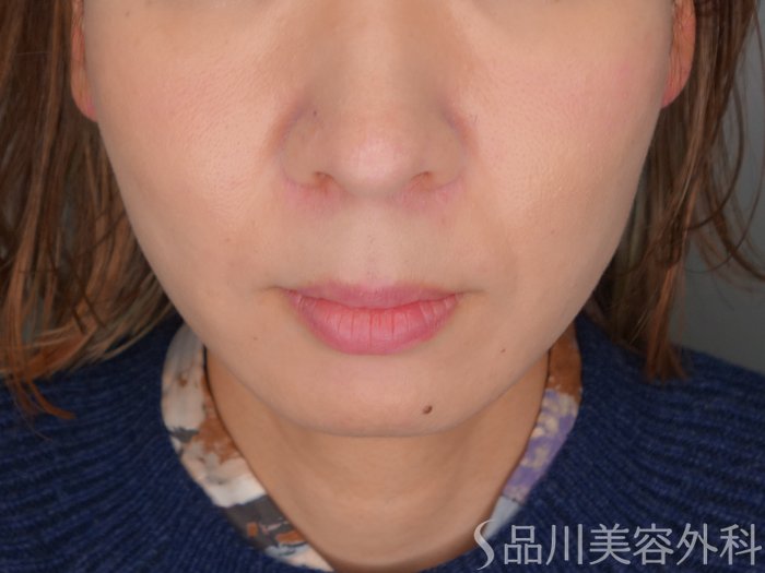 症例NO.70584のAFTER写真