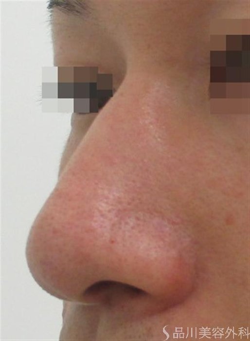 症例NO.22954のBEFORE写真