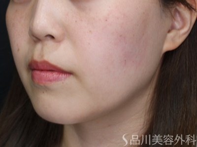 症例NO.72167のAFTER写真