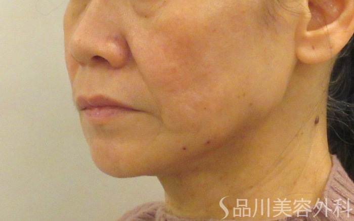 症例NO.72673のAFTER写真