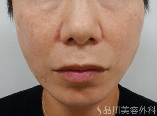 症例NO.73209のAFTER写真