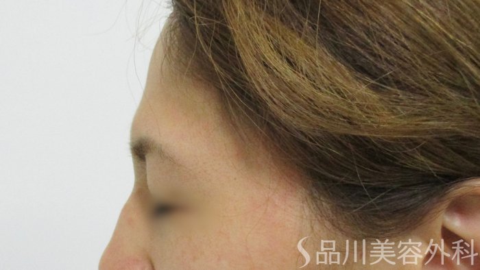 症例NO.63543のBEFORE写真