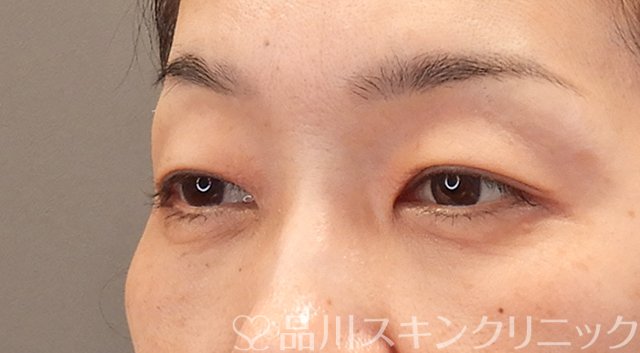 症例NO.75318のAFTER写真