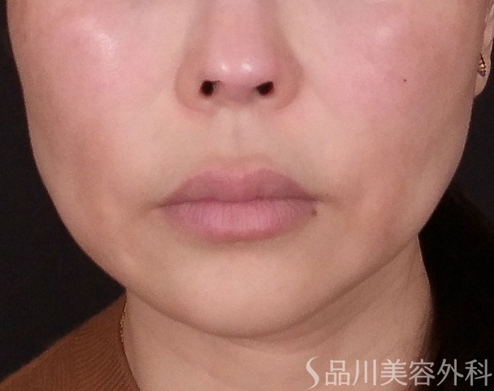 症例NO.69415のBEFORE写真