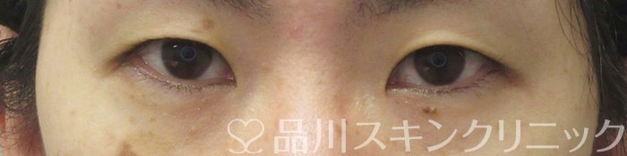 症例NO.73935のBEFORE写真