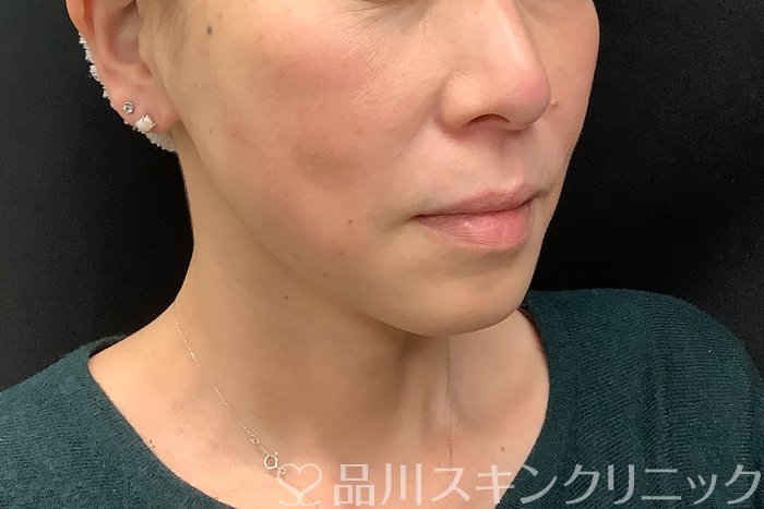 症例NO.71293のAFTER写真