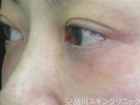 症例NO.60611のAFTER写真