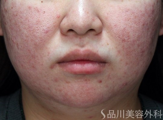 症例NO.70259のBEFORE写真