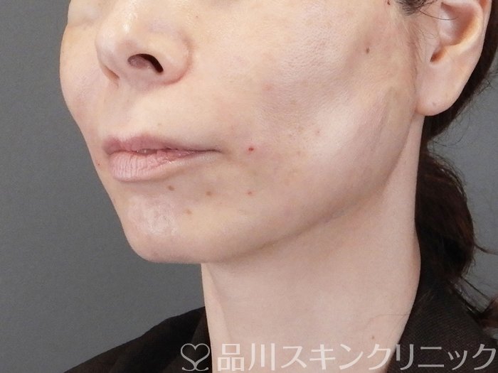 症例NO.75271のAFTER写真