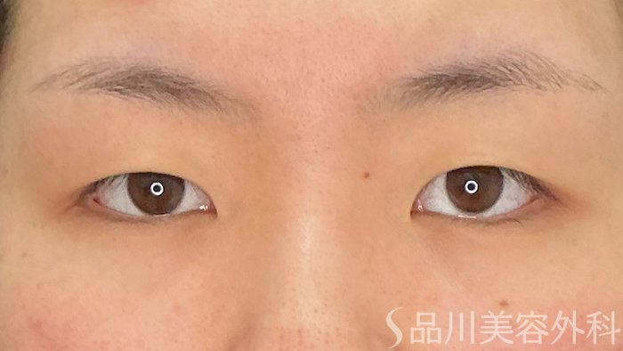 症例NO.72141のBEFORE写真