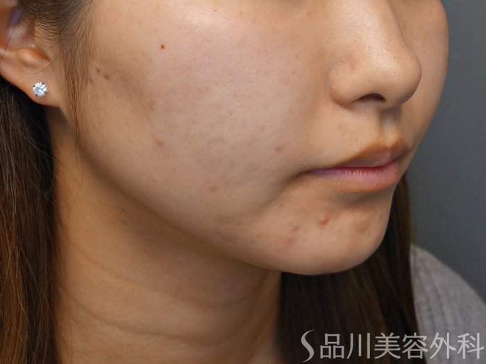 症例NO.70841のBEFORE写真