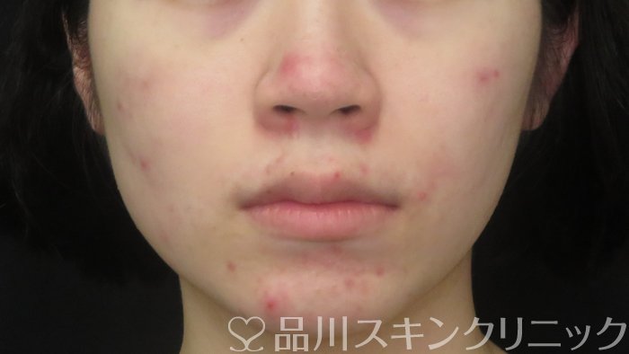 症例NO.71888のBEFORE写真