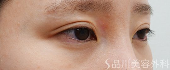 症例NO.70161のBEFORE写真
