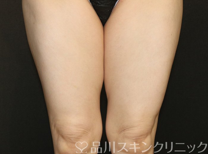 症例NO.72808のBEFORE写真