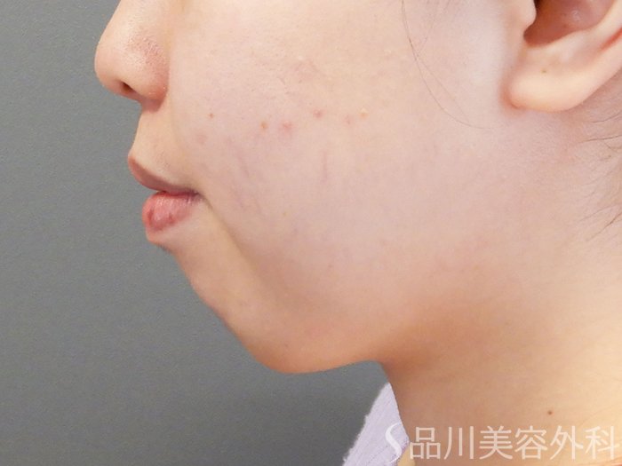 症例NO.70194のBEFORE写真
