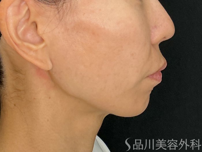 症例NO.72733のBEFORE写真