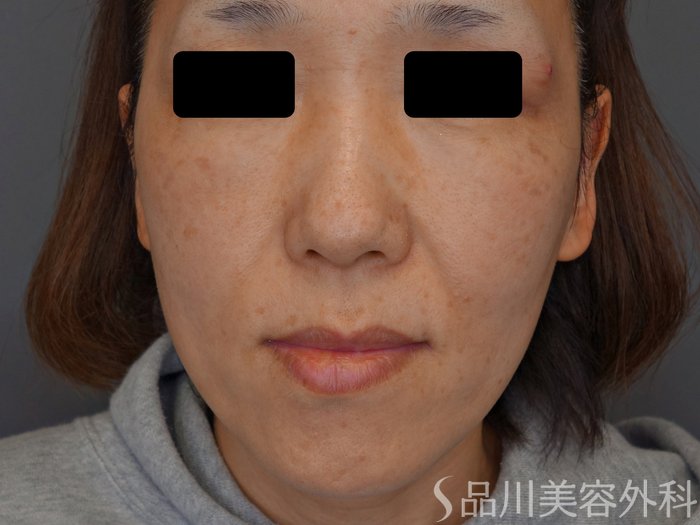 症例NO.75032のBEFORE写真