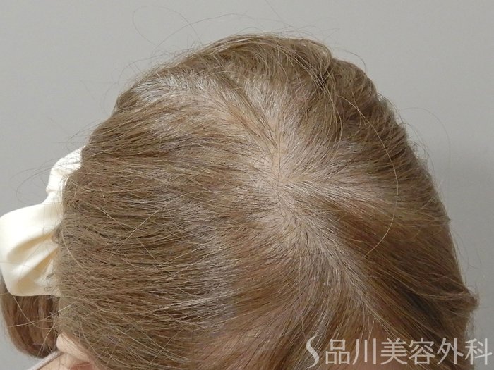 症例NO.69782のBEFORE写真