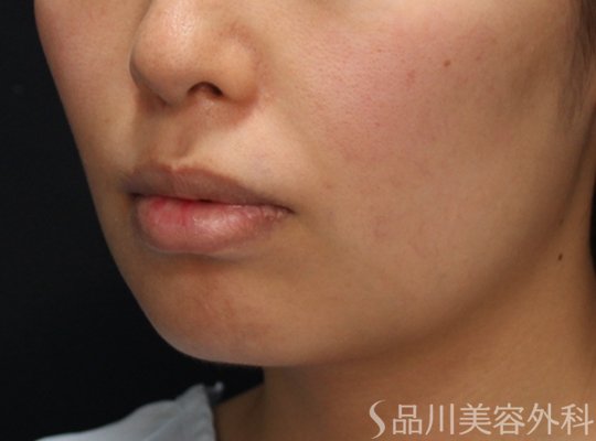 症例NO.73863のBEFORE写真