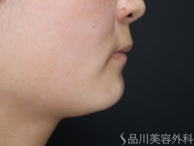 症例NO.70008のBEFORE写真