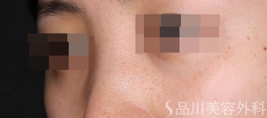 症例NO.74393のAFTER写真