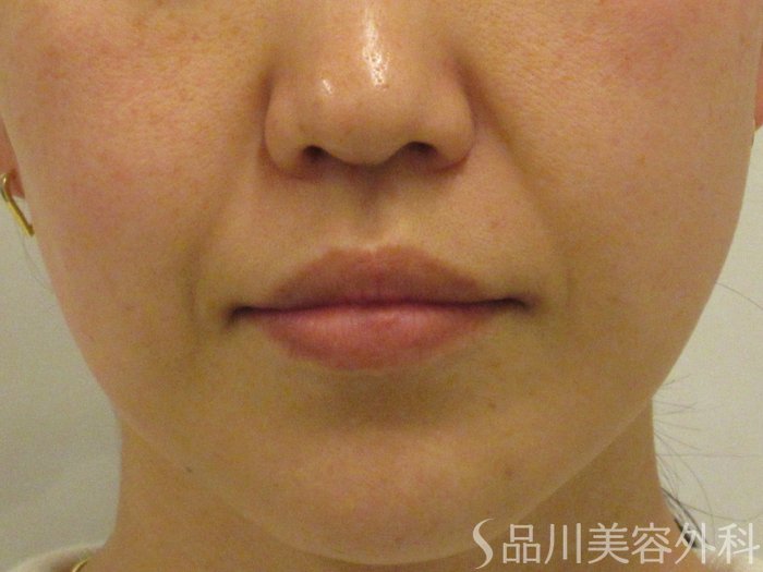 症例NO.74671のBEFORE写真