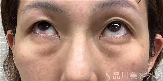 症例NO.55312のBEFORE写真