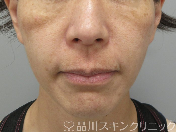 症例NO.70671のBEFORE写真