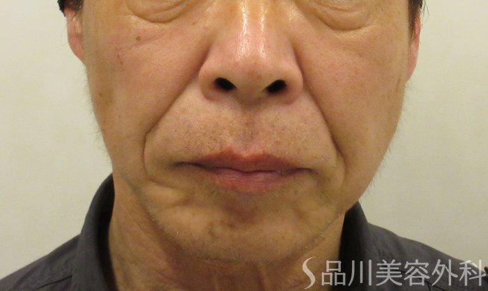 症例NO.73296のBEFORE写真