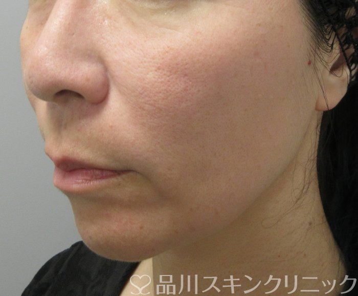 症例NO.74197のAFTER写真