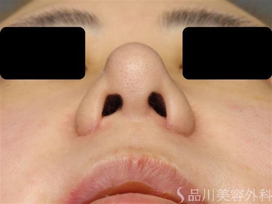 症例NO.57461のAFTER写真