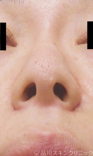 症例NO.71125のAFTER写真