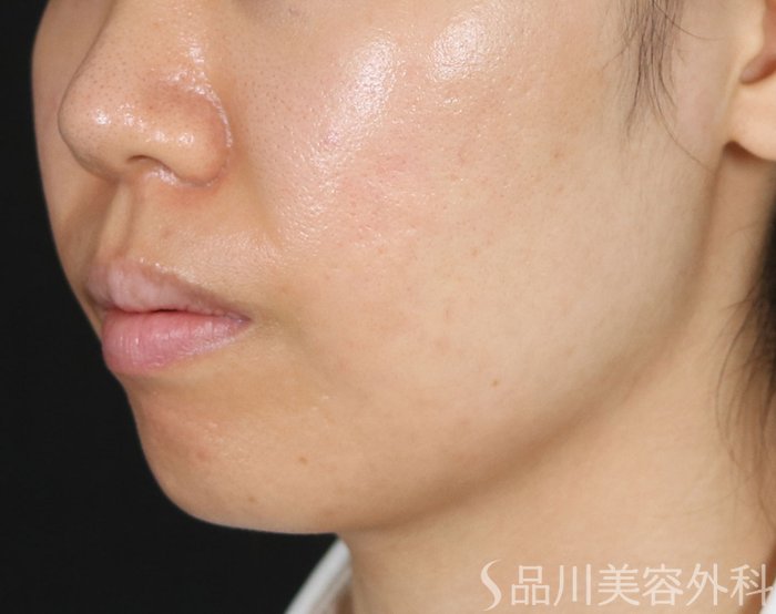 症例NO.71920のAFTER写真