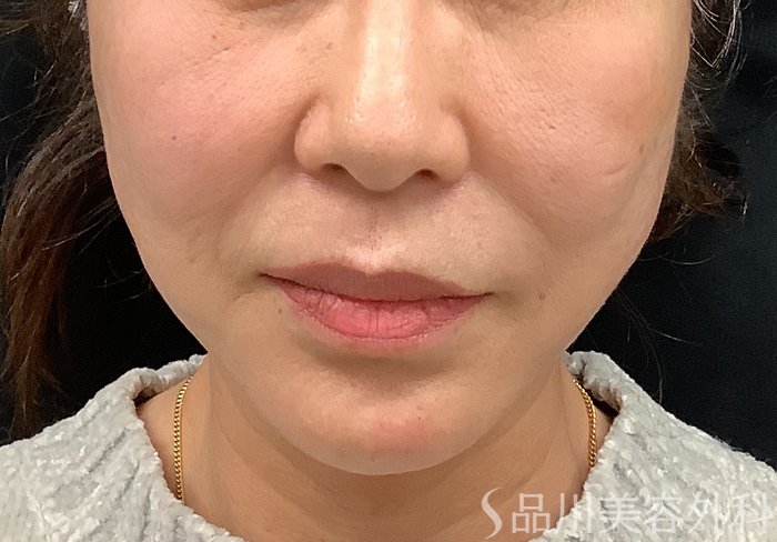 症例NO.67964のAFTER写真