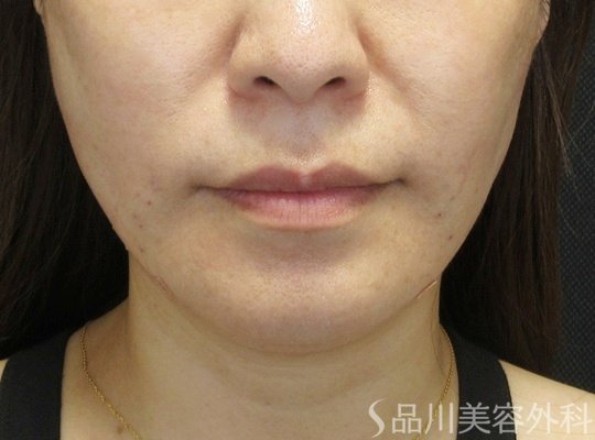 症例NO.71387のAFTER写真