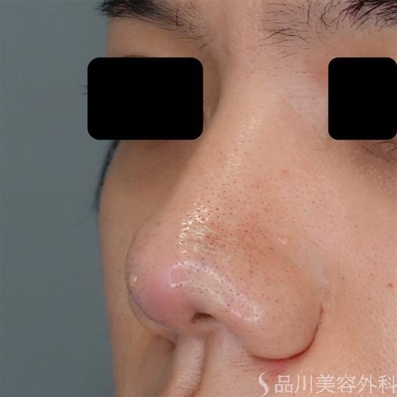 症例NO.50371のAFTER写真