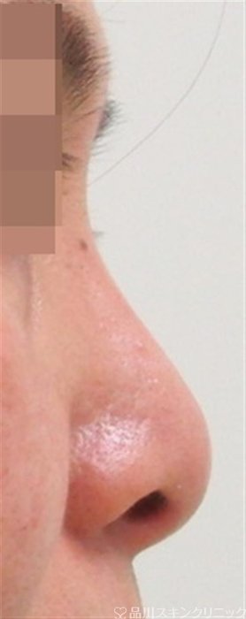 症例NO.34505のBEFORE写真