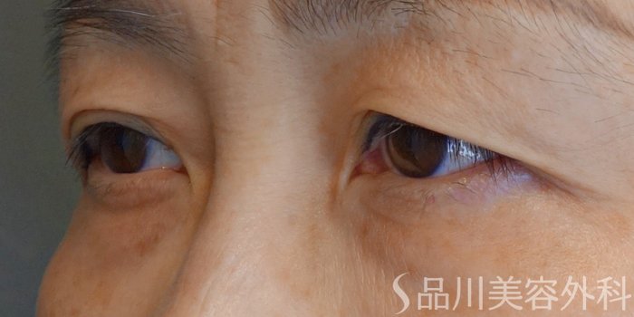 症例NO.68199のBEFORE写真