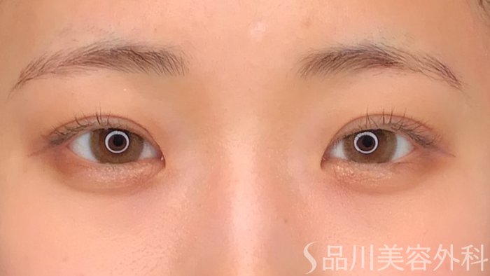 症例NO.64751のAFTER写真