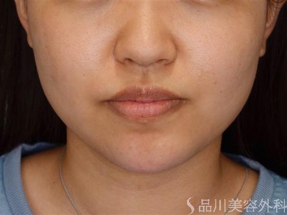 症例NO.51066のAFTER写真