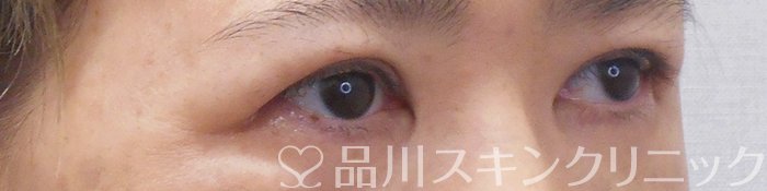 症例NO.70868のAFTER写真