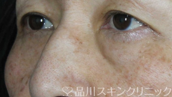 症例NO.71730のBEFORE写真