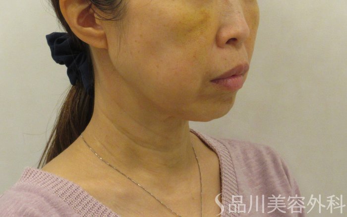 症例NO.72525のBEFORE写真