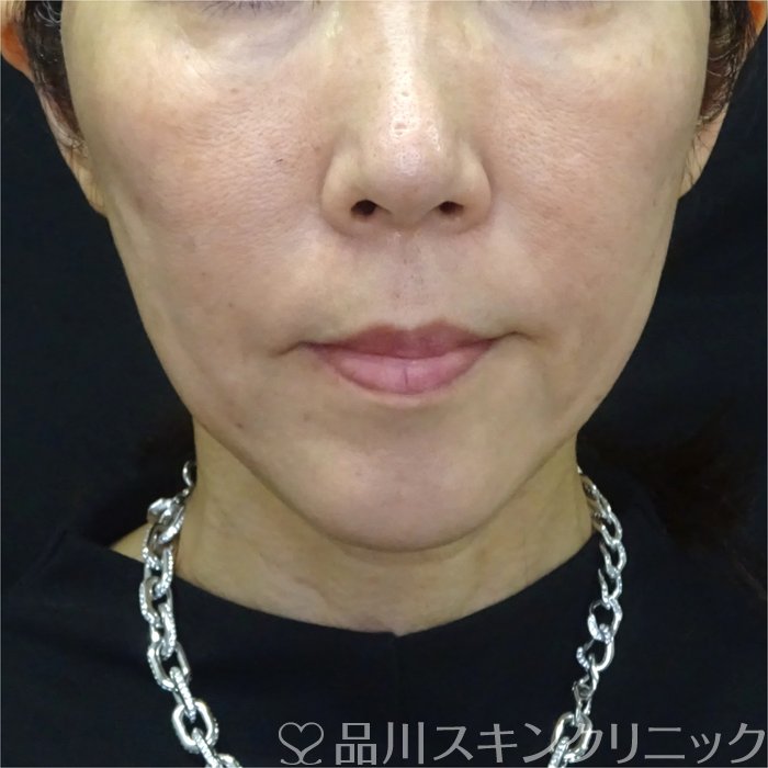 症例NO.71173のAFTER写真