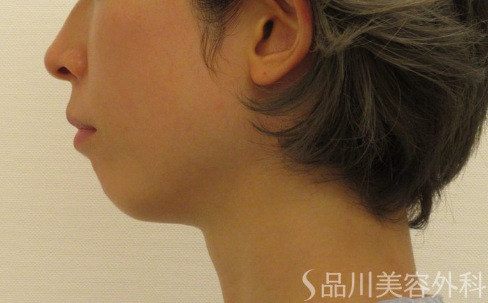 症例NO.70700のBEFORE写真