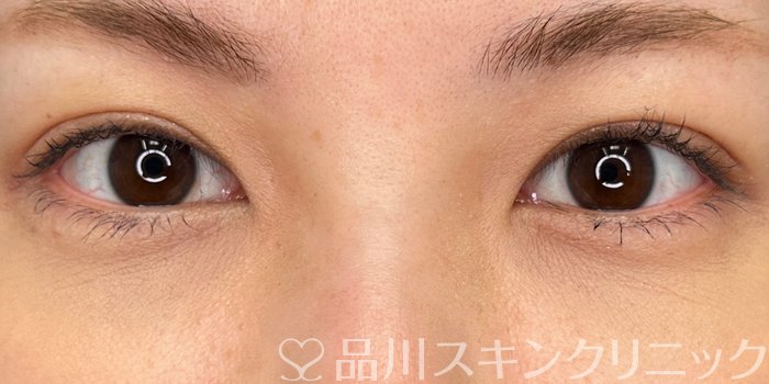 症例NO.65525のAFTER写真