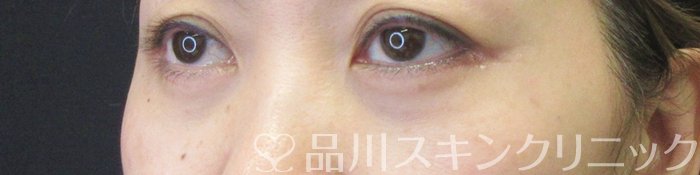 症例NO.68654のAFTER写真