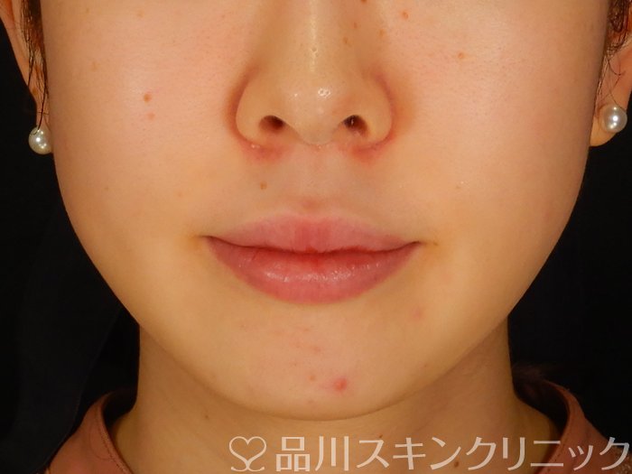 症例NO.68640のAFTER写真