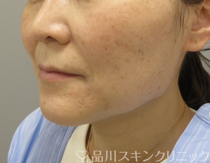 症例NO.74719のBEFORE写真