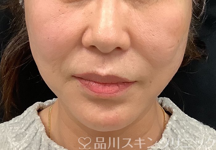 症例NO.67964のAFTER写真